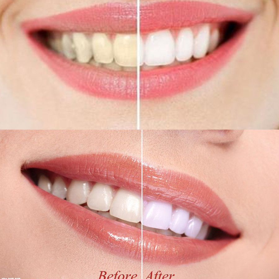 Bambu kömür diş diş diş hekimi - Teeth Whitening Filter incelemesi ve fiyatı